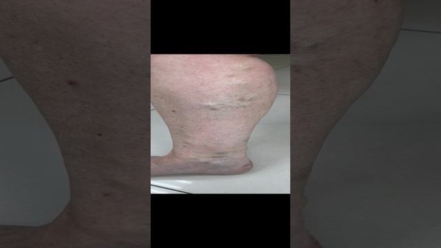 Варикоз на ногах. Как лечить варикоз? Флеболог Москва. Флеболог