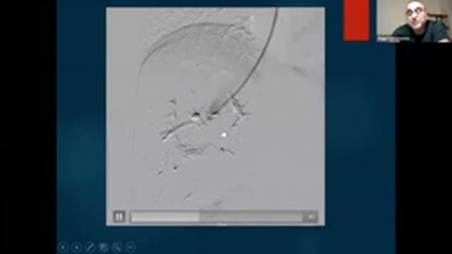 GAW 5.3 Embolizasyon Splenik, hepatik pelvik смотреть онлайн