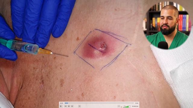 Cómo poner ANESTESIA LOCAL para drenar un ABSCESO. Video REAL explicado смотреть онлайн