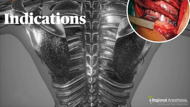 Межреберная блокада под УЗ-навигацией смотреть онлайн