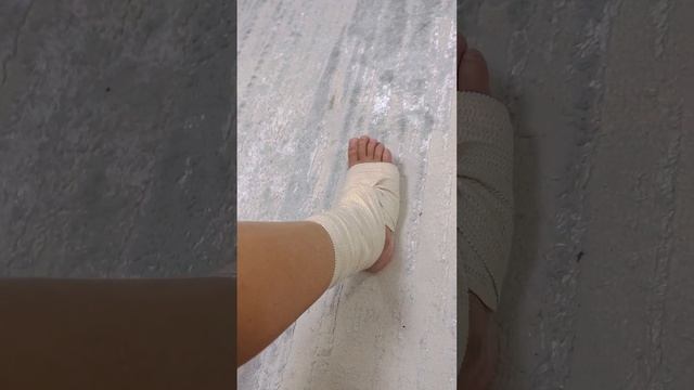 перелом лодыжки, сняли гипс на 30 день смотреть онлайн