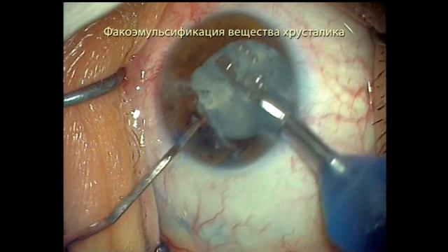 Стекло в хрусталике смотреть онлайн