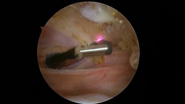 R Suprapectoral Biceps Tenodesis 8 4 22 WE