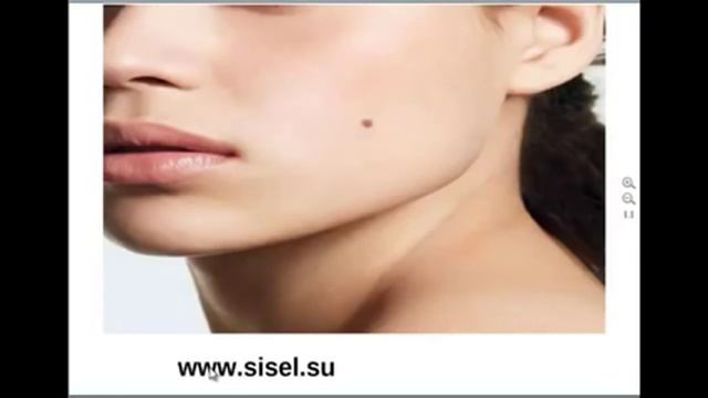 Родинки. Значение родинок. Удаление родинок смотреть онлайн