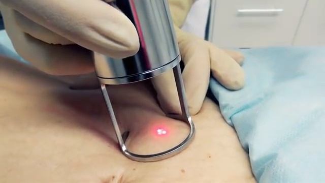 Лазерная шлифовка растяжек смотреть онлайн