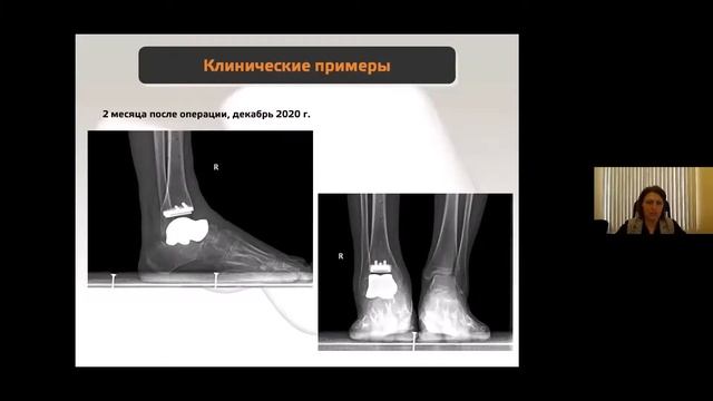 Лекция Карлова А.В. Инновационные технологии керамического эндопротезирования 10 февраля 2021 смотреть онлайн