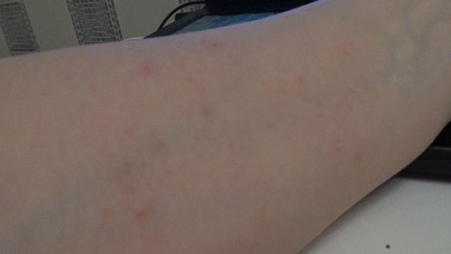 Аллергия на шоколад. Это не лечится))))))))))))