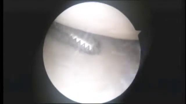 DP L Shoulder Biceps Tenodesis 3.30.15