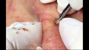 Удаление акне!Прыщи выдавливание!Выдавливание прыщей! 03