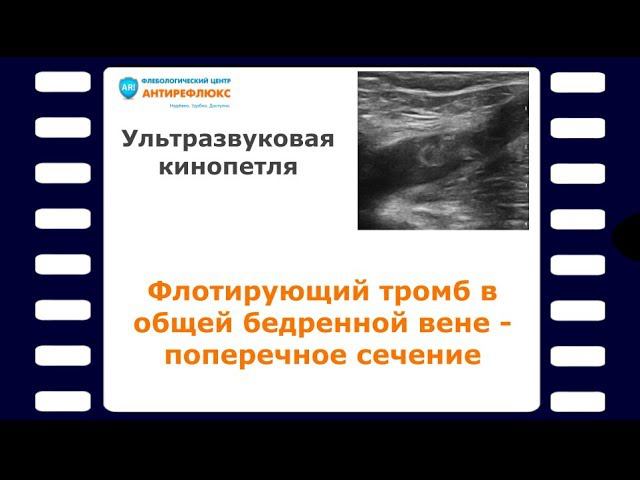 Флотирующий тромб в общей бедренной вене - поперечное сечение смотреть онлайн