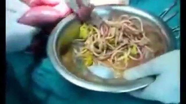 Operation intestinal worms Ascariasis bolus смотреть онлайн