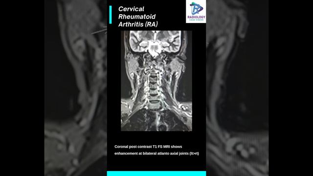 Cervical Rheumatoid Arthritis смотреть онлайн