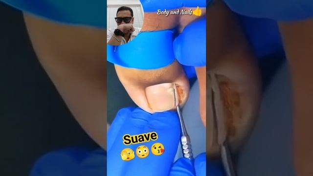 Suave ??? #relaxingvideo #ingrown_toenail #pedicure #podiatrist смотреть онлайн