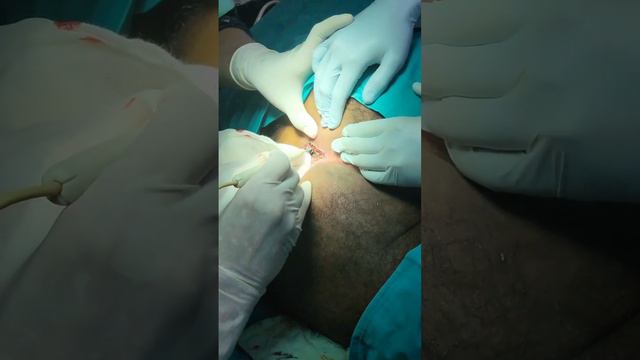 SURGERY OF A PILONIDAL SINUS AND ANAL FISSURE TOGETHER- A CASE REPORT смотреть онлайн