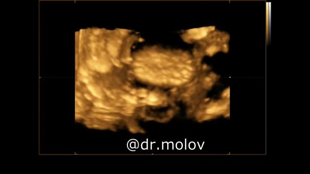 Киста почки с камнями. УЗИ почек смотреть онлайн