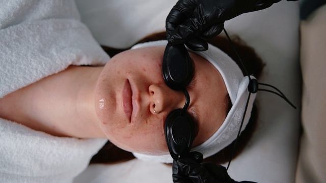 Фототерапия BBL