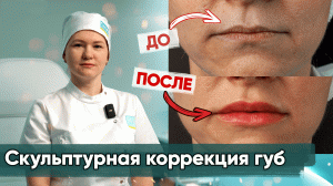 Коррекция губ филлером