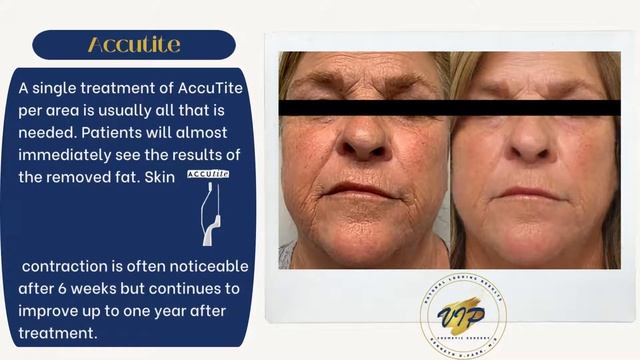what is Morpheus 8 & Facetite? The benefits & before & after pictures of each смотреть онлайн