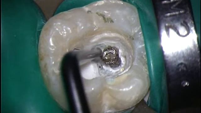 Ультразвуковая насадка Start-X™ для создания эндодонтического доступа. Насадка 4 из 5 смотреть онлайн