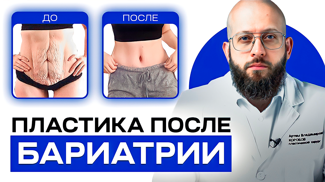 Пластика после бариатрии смотреть онлайн