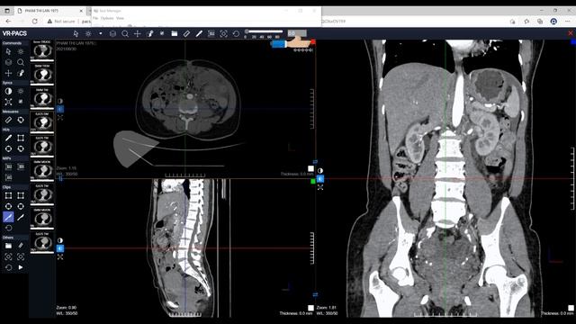 [VR-PACS] MPR-VRT HTML5 Zero-footprint DICOM Web Viewer смотреть онлайн