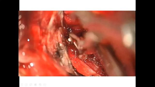 Rare Vascular Lesions of posterior fossa | Neurosurgical TV смотреть онлайн