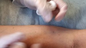 Электрокоагуляция гемангиомы на теле