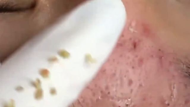 Убираем угри и чёрные точки