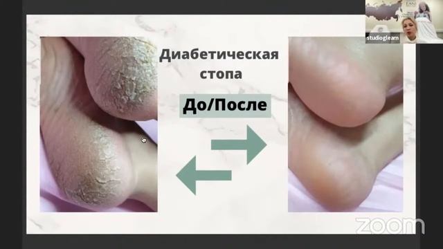 Проблемы стоп, которые решаются с помощью Fani Ben Ami смотреть онлайн