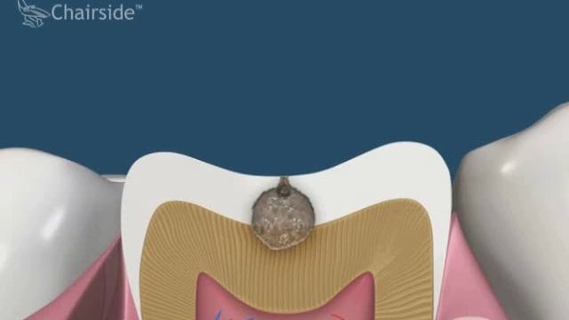 Зубные герметики смотреть онлайн