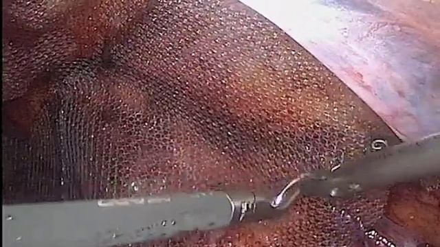 Ущемленная грыжа TAPP.