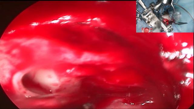 Новообразование гипофиза смотреть онлайн