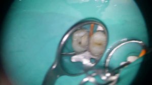 Помощь при острой зубной боли ( пульпит )