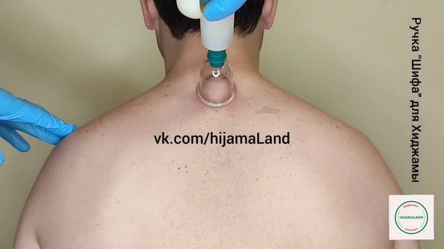 Точки Хиджамы для лечения бессонницы, депрессии, психоза и синдрома хронической усталости.