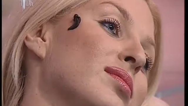 Гирудотерапия. Часть 1.