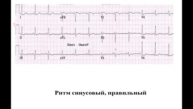 13:50 Методика расшифровки ЭКГ смотреть онлайн