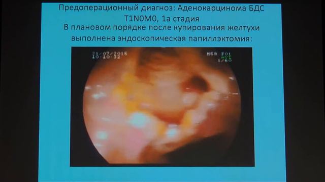 20 Халин КД – Эндоскопическая папиллэктомия – тернистый путь к успеху смотреть онлайн