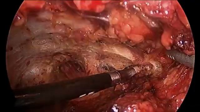 17.218GS Videoscopic Inguinal Lymphadenectomy смотреть онлайн