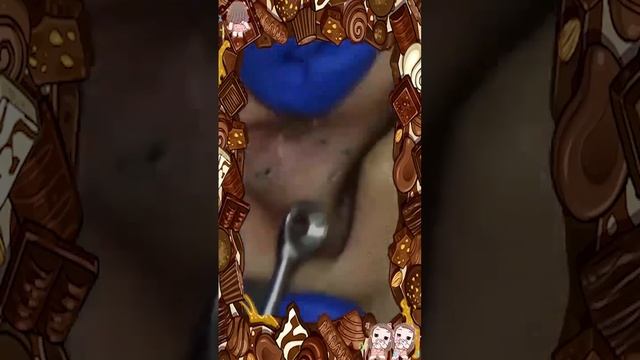 Blackheads Removal Whiteheads Cystic Acne Treatment Pimple Popping Remove Milia On Skin