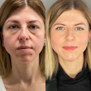 Нижняя блефаропластика: ДО и ПОСЛЕ☀