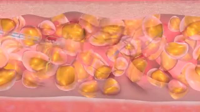 Body Jet водоструйная липосакция в ЦИДК смотреть онлайн