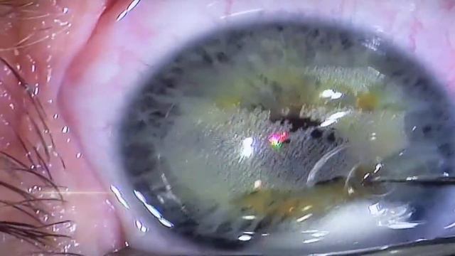Bausch+Lomb - Flaps Procedure with VICTUS смотреть онлайн