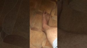 Перелом лодыжки снял гипс раньше срока