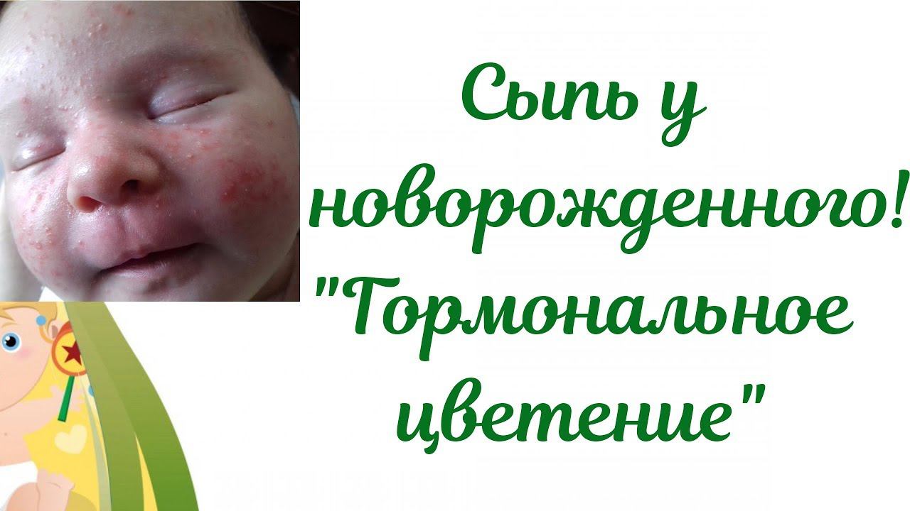 Акне новорожденных! Сыпь у новорожденного ребенка"Гормональное цветение" смотреть онлайн