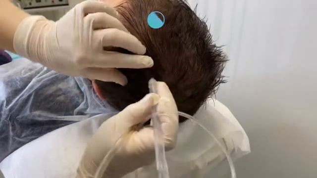 Пилинг кожи головы JetPeel