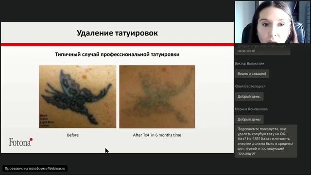 Вебинар Fotona: Удаление татуировок лазером StarWalker смотреть онлайн