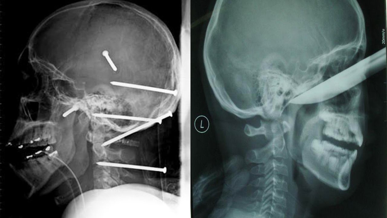 ? 10 Поразительных вещей, найденных внутри человека. смотреть онлайн