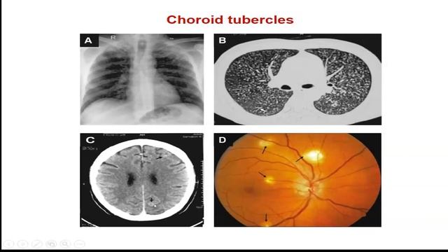 CME program on Extra-Pulmonary TB - Session II смотреть онлайн