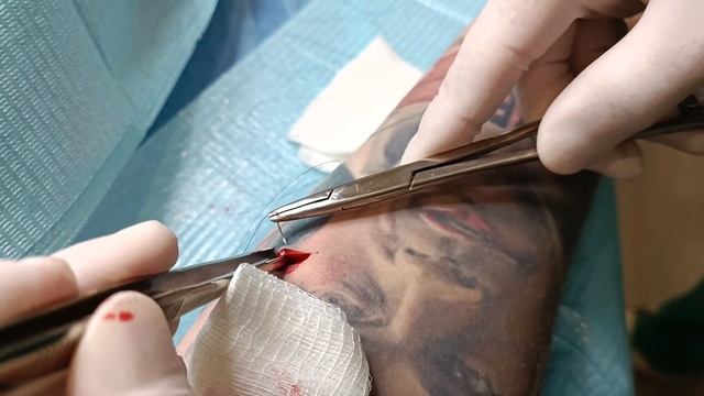 Удаление липомы под татуировкой смотреть онлайн