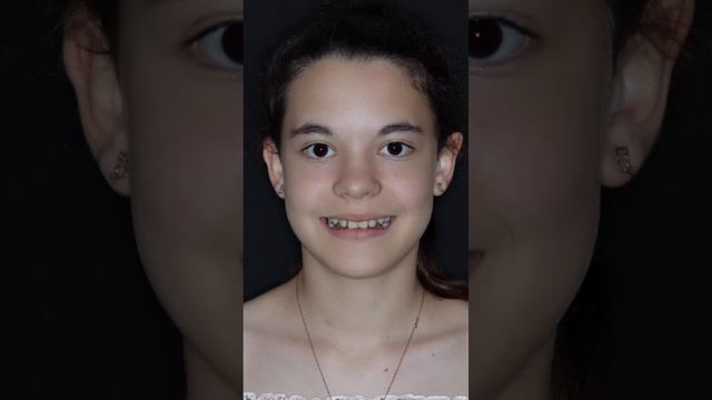 ? Глубокий прикус. Клинический случай Дентал Фэнтези